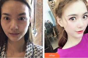 深圳?，斄猪槼毖劭漆t(yī)院袁野整形價格表附眼部修復案例展示