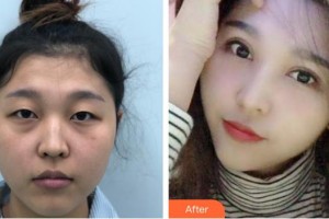 深圳?，斄猪槼毖劭漆t(yī)院林小銘整形價格表附眼部綜合案例展示