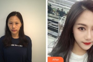 深圳?，斄猪槼毖劭漆t(yī)院石峰整形價格表附眼部修復案例展示