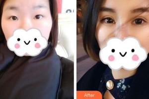 深圳?，斄猪槼毖劭漆t(yī)院范偉整形價格表附眼部綜合案例展示