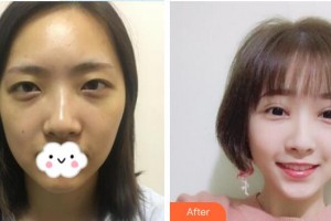 深圳華夏眼科醫(yī)院韓冰整形價格表附切開雙眼皮案例展示