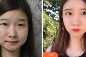 深圳?，斄猪槼毖劭漆t(yī)院林妙麗整形價格表附眼部整形雙眼皮案例展示