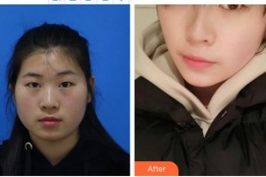 深圳?，斄猪槼毖劭漆t(yī)院陳麗珍整形價格表附眼部綜合案例展示