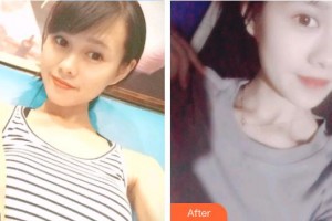 深圳?，斄猪槼毖劭漆t(yī)院江英整形價格表附開內(nèi)眼角案例展示