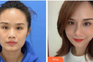 深圳華夏眼科醫(yī)院朱少棟整形價格表附雙眼皮案例展示
