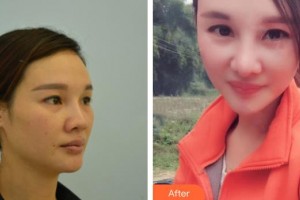 懷化市第一人民醫(yī)院廖明星整形價(jià)格表附假體隆鼻案例展示