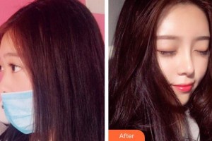 懷化市第一人民醫(yī)院吳文潔整形價(jià)格表附肋軟骨隆鼻案例展示