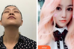 東莞康華醫(yī)院整形美容中心王春梅整形價格表附假體隆鼻案例展示