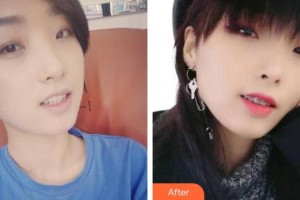 東莞特美口腔門診部郭憲碧整形價格表附金屬托槽矯正案例展示