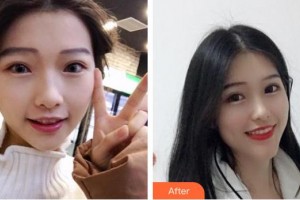 東莞華美醫(yī)療美容醫(yī)院劉江整形價格表附超聲波潔牙案例展示