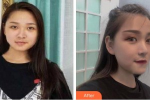 東莞美立方美容醫(yī)院張志勇整形價格表附鼻部綜合案例展示