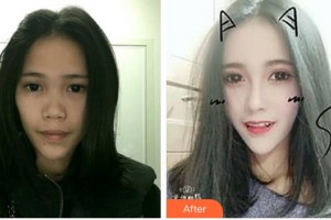 東莞美極醫(yī)療美容門診部鄭友玲整形價格表附肋軟骨隆鼻案例展示