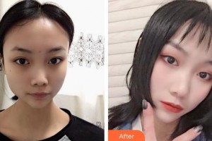 東莞百佳瑪麗亞婦產(chǎn)醫(yī)院李雪琴整形價格表附鼻部綜合案例展示