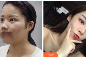 東莞華美醫(yī)療美容醫(yī)院邵天如整形價格表附鼻部綜合案例展示