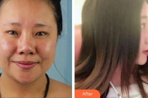 東莞華美醫(yī)療美容醫(yī)院羅日云整形價格表附鼻部綜合案例展示