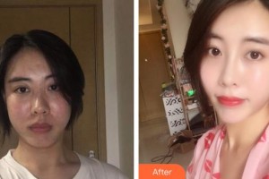 東莞韓美整形醫(yī)院唐可整形價格表附鼻部綜合案例展示