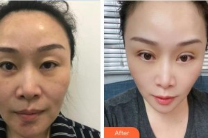 東莞愛爾眼科醫(yī)院華山整形價(jià)格表附切眉術(shù)案例展示