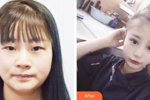 東莞華廈眼科醫(yī)院梁秀棟整形價(jià)格表附眼部綜合案例展示