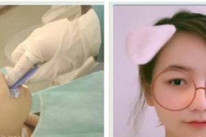 東莞南城固德口腔門診部何繼帥整形價(jià)格表附隱形托槽矯正案例展示