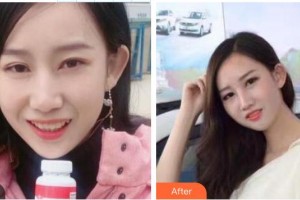 東莞南城固德口腔門診部黃城整形價(jià)格表附牙齒隱形矯正案例展示