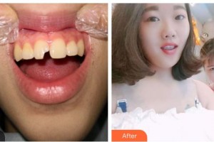 東莞恒生口腔門診部張業(yè)俊整形價(jià)格表附美白貼片案例展示