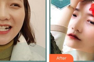 東莞臺心醫(yī)院口腔科徐文平整形價(jià)格表附牙齒矯正案例展示