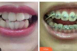 東莞臺心醫(yī)院口腔科曾思整形價(jià)格表附金屬托槽矯正案例展示