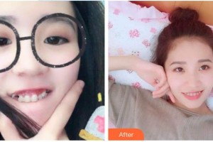 景德鎮(zhèn)圣嘉麗醫(yī)療美容門診部劉志強(qiáng)整形價格表附牙齒隱形矯正案例展示