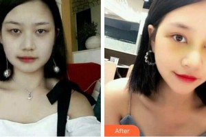 景德鎮(zhèn)亞菲整形美容醫(yī)院李澤偉整形價格表附埋線雙眼皮案例展示