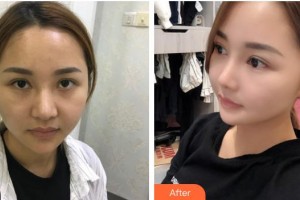 潮州博蘭雅醫(yī)療美容門診部茍上財(cái)整形價(jià)格表附墊鼻基底案例展示
