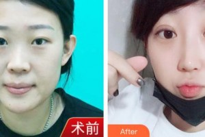 潮州博蘭雅醫(yī)療美容門診部倪絢整形價(jià)格表附鼻部綜合案例展示