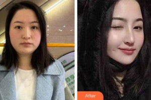 潮州華美醫(yī)療美容門診部林康維整形價(jià)格表附鼻部綜合案例展示