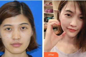 溫嶺醫(yī)美佳醫(yī)療美容診所楊金君整形價(jià)格表附激光美膚激光案例展示