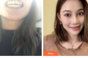 溫嶺口腔醫(yī)院顧偉煒整形價(jià)格表附牙齒隱形矯正案例展示