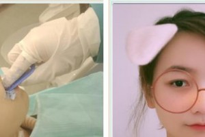 溫嶺口腔醫(yī)院林宣均整形價(jià)格表附牙齒隱形矯正案例展示