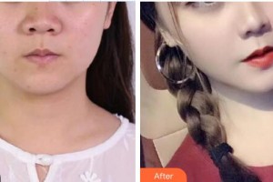 延吉尹世整形美容醫(yī)院尹慶愛整形價(jià)格表附激光美膚激光案例展示