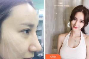 延吉王桂英醫(yī)療美容診所王桂英整形價(jià)格表附埋線提升案例展示