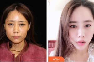 延吉趙美花保健醫(yī)學(xué)美容醫(yī)院許一整形價(jià)格表附埋線提升案例展示