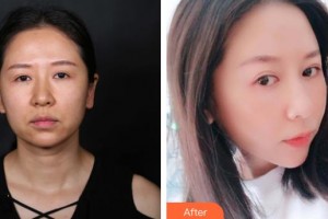 延吉趙美花保健醫(yī)學(xué)美容醫(yī)院李勇整形價(jià)格表附埋線提升案例展示