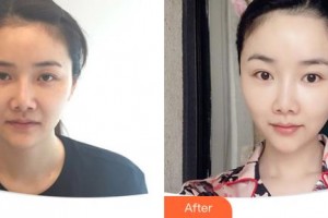 延吉董昌林醫(yī)學(xué)美容醫(yī)院李英玉整形價格表附埋線提升案例展示