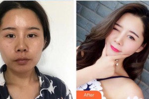 延安儷人醫(yī)院整形美容中心王英俊整形價(jià)格表附肋軟骨隆鼻案例展示