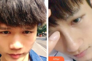 延安大學(xué)附屬醫(yī)院燒傷整形科楊喜明整形價(jià)格表附鼻部綜合案例展示