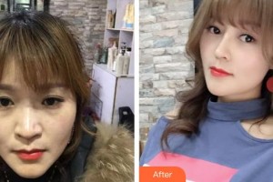 延安大學(xué)附屬醫(yī)院燒傷整形科李明整形價(jià)格表附肋軟骨隆鼻例展示