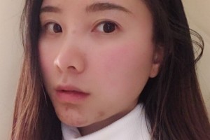 鄭州美立方醫(yī)院怎么樣？熱瑪吉2021價格分享附案例