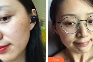 奉化市中醫(yī)醫(yī)院整形外科胡玉春整形價格表附激光美膚激光案例展示