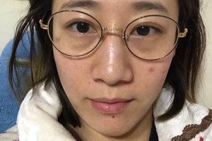 北京大學第一醫(yī)院皮膚科激光祛斑怎么樣附果圖