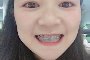 上海拜博口腔牙齒矯正怎么樣附果圖