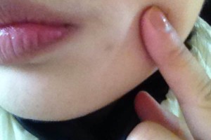 武漢協(xié)和醫(yī)院脫唇毛價格多少錢附價格表|醫(yī)生推薦