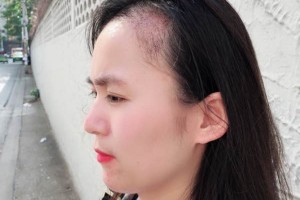 廣西醫(yī)科大一附院有稙發(fā)嗎？附發(fā)際線種植果圖