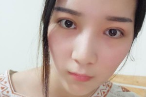 徐州市二院整形科怎么樣？附埋線雙眼皮果圖